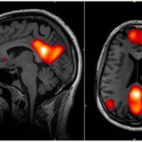 The Default Mode Network